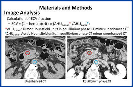 図1　膵臓がんにおけるCTのECV解析方法