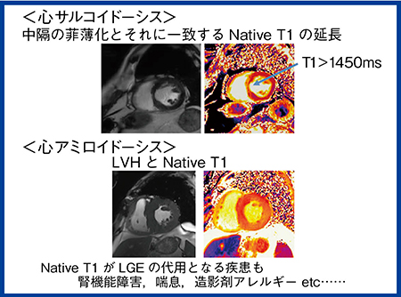 図5　Native T1による非造影の心サルコイドーシス，心アミロイドーシスの解析