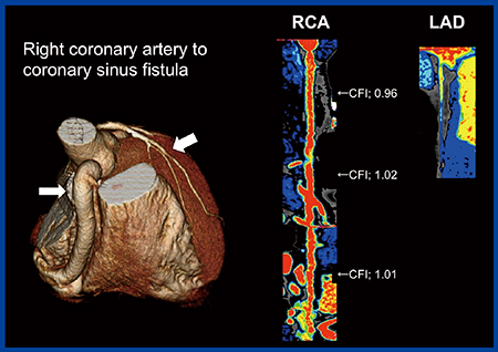 図2　右冠動脈と右室瘻孔形成の冠動脈フローマップ