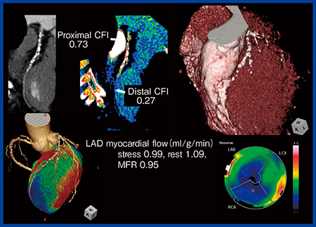 図3　冠動脈フローマップとアンモニアPETのMFRによる機能的虚血の評価 60歳代，男性，LADとRCAに強い石灰化を伴った狭窄が認められる。