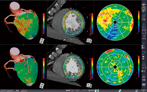 図2　CT心筋血流解析の解析画面