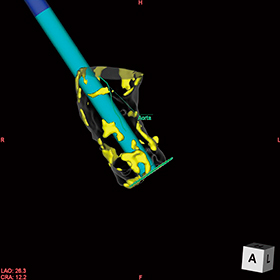 図3　Direct aortaアプローチシミュレーション