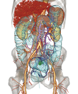 図1　直腸がん術前CTより作成された術前3D画像