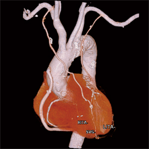 図2　冠動脈バイパス術後患者の自動抽出結果