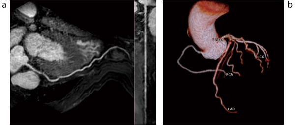 図3　MR冠動脈解析 a：MR画像から自動抽出された右冠動脈のCPRとs-CPR b：冠動脈の自動ラベリング