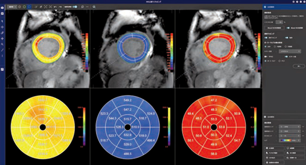 図1　MR心筋T1マッピング