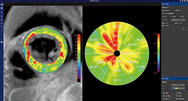 図2　MR心筋T2マッピング