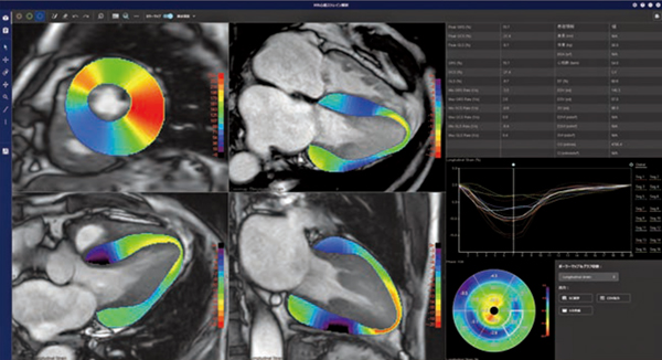 図3　MR心筋ストレイン解析