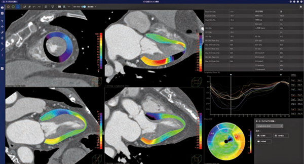 図4　CT心筋ストレイン解析（W.I.P.）