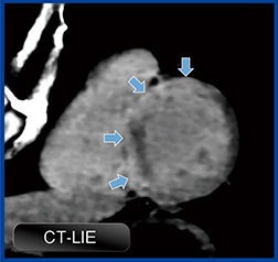 図3　CT遅延造影：心サルコイドーシス