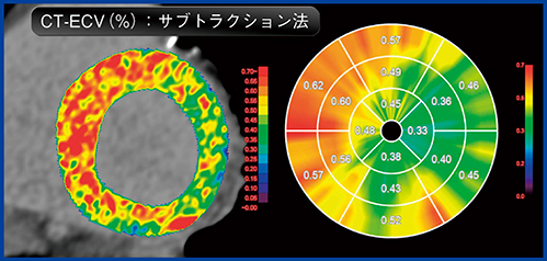 図5　心臓CTによるECV評価（サブトラクション法）：心アミロイドーシス