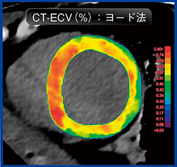 図6　心臓CTによるECV評価（ヨード法）：心アミロイドーシス