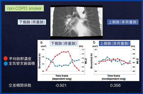 図1　気流制限のない喫煙者の側臥位における荷重肺と非荷重肺の比較9）