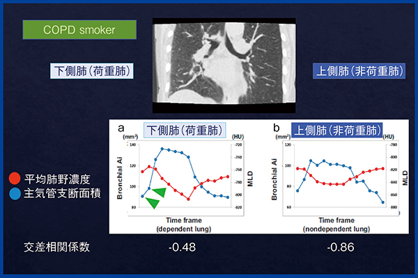 図2　気流制限を有する喫煙者の側臥位における荷重肺と非荷重肺の比較9）