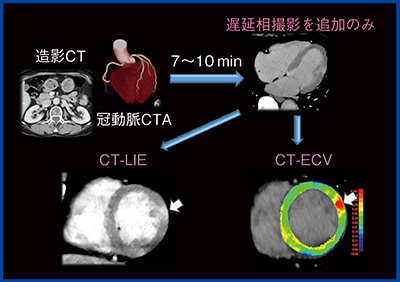 図3　心臓CTによる心筋評価