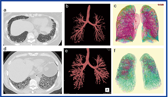 図1　リウマチ肺のCT所見とその解析結果