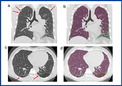 図2　特発性肺線維症のCT画像とQZIP-ILDの解析結果
