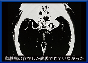 図1　初めて3D-CTAで動脈瘤を描出できた症例（1992年）