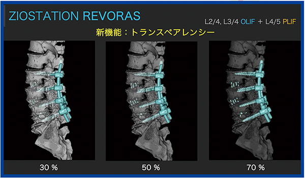図4　“トランスペアレンシー”による椎体固定術後CTの3D Bone＋Device画像