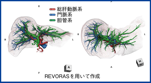 図1　グリソン鞘（動脈＋門脈＋胆管）のフュージョン画像