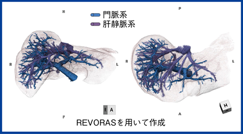 図2　門脈＋肝静脈のフュージョン画像