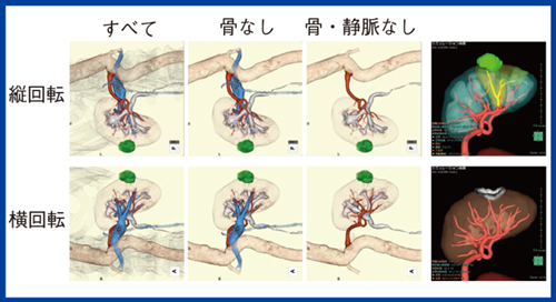 図1　ロボット支援下腎部分切除術（RAPN）の手術支援画像