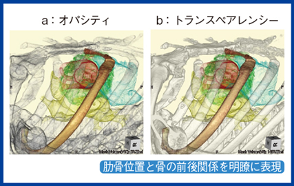 図3　トランスペアレンシーで作成したMICS AVR術前画像