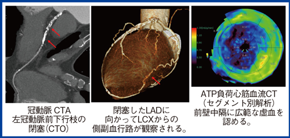 図1　左冠動脈前下行枝閉塞症例の負荷心筋perfusion CT