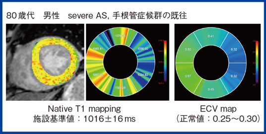 図3　心アミロイドーシスのMRI T1mappingとECV