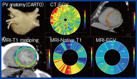 図5　Ziostation REVORASのMRI，CTでのECV解析