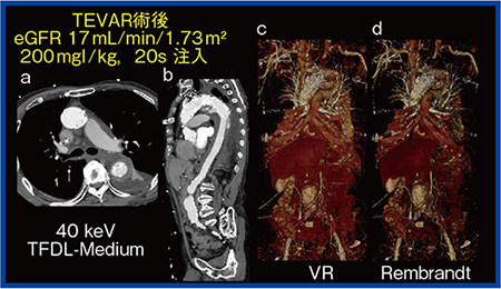 図1　造影剤減量CT angiography