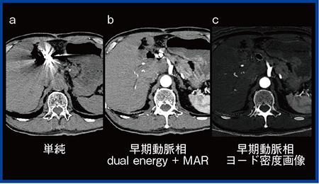 図2　TAE後血管評価