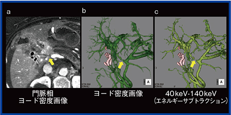 図4　門脈ステント術前3D CT