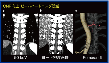 図5　Adamkiewicz動脈CT angiography