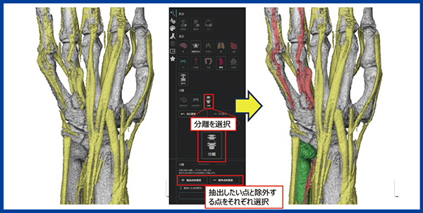 図2　REVORASによる「目的部位抽出」 環指・小指の断裂した伸筋腱とその原因である亜脱臼した尺骨の分離
