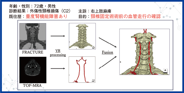 図3　ヨード造影剤アレルギー患者の術前検査 “非造影”+“ミスレジストレーションなし”で患者それぞれで異なる環軸椎周辺の椎骨動脈の血管走行が把握可能