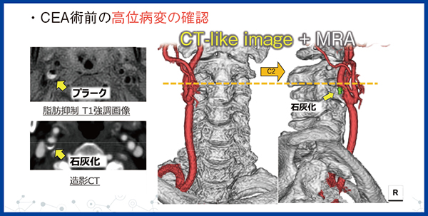 図4　脳神経外科領域での使用：CEA術前の高位病変の確認