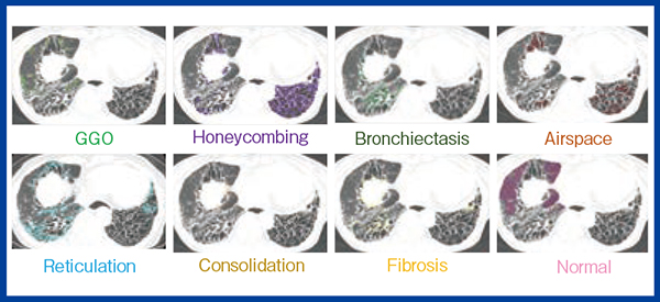 図2　QZIP-ILDを用いた間質性肺陰影の自動セグメンテーション