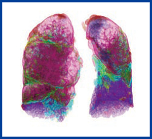 図3　間質性肺陰影の3D表示