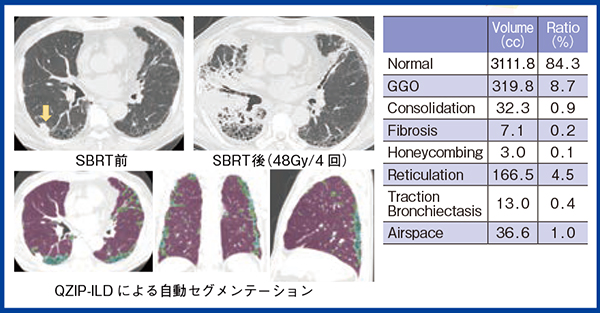 図4　QZIP-ILDによるRPの評価