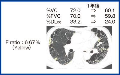図5　症例1：80歳代，男性，n-res