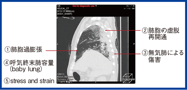 図2　4D-CTによる局所および肺容積の可視化