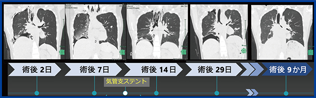 図4　左主気管支狭窄　P-SILIによる肺損傷および横隔膜の運動傷害の機序と回復過程