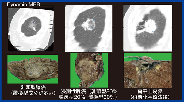 図6　肺結節のDynamic MPR