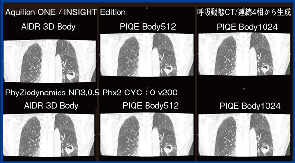 図7　‌最新ADCTとPhyZiodynamicsによる呼吸動態CT