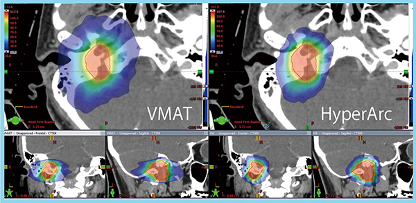 図2　頭蓋底腫瘍へのHyperArcの適応