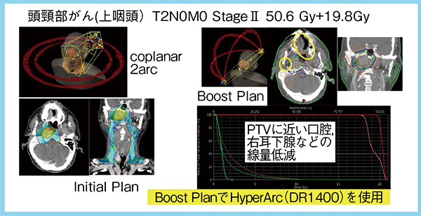 図1　上咽頭がん症例へのHyperArcの応用