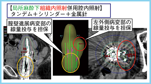 図2　組織内照射を毎回併用した症例