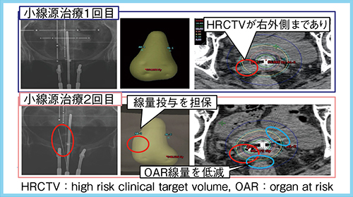 図3　腔内照射から組織内照射併用へ手技変更した症例