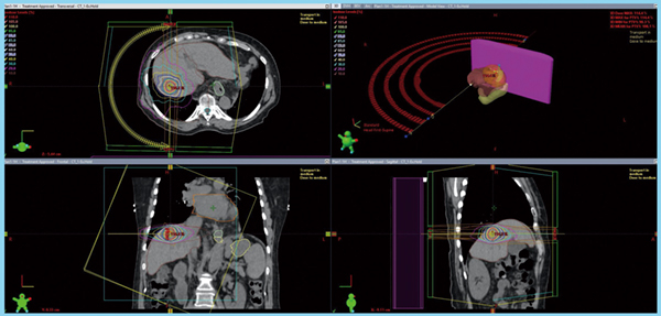 SBRTの繰り返し治療を受けることはできますか?